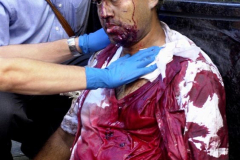 Silvion Ramsundar is treated for injuries he sustained when United Airlines Flight 175 slammed into the South Tower of the World Trade Center as he waited for an elevator with his co-workers on the 78th floor. "We were thinking the plane that hit the North Tower was an accident," Ramsundar says. When the plane hit, he was hurled through the air by a tornado-like blast that killed the nearly 25 colleagues with whom he was standing. Ramsundar has survived two WTC blasts. He was in the building when terrorists exploded a truck bomb in 1993.  9/11/01